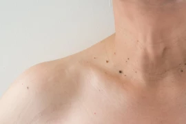 Wart vs. Skin Tag: What's The Difference & How To Treat Them