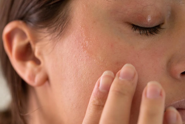 What Is Dry Skin And How To Treat It?