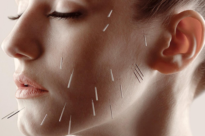 Facial Acupuncture