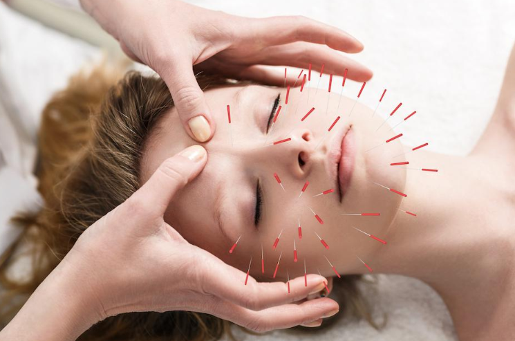 Facial Acupuncture Treatment Process