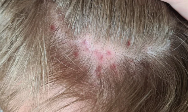 Scalp Folliculitis