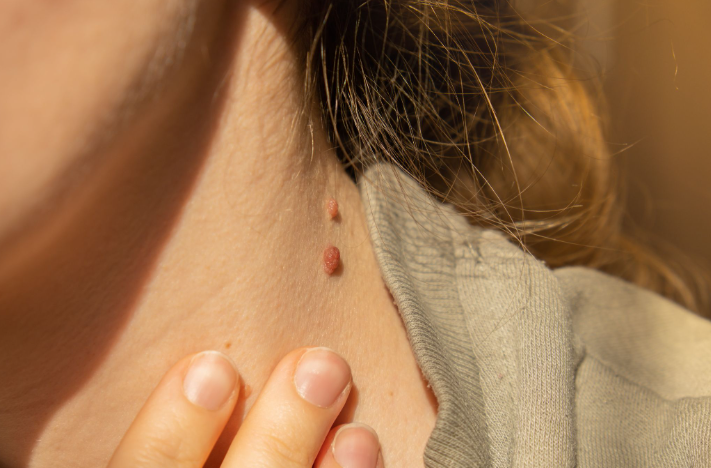 A Step-by-Step Guide On How To Remove Skin Tags