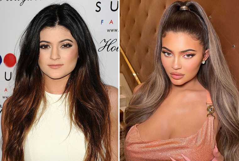 Kylie Jenner's Lip Filler Journey: What She Has Revealed