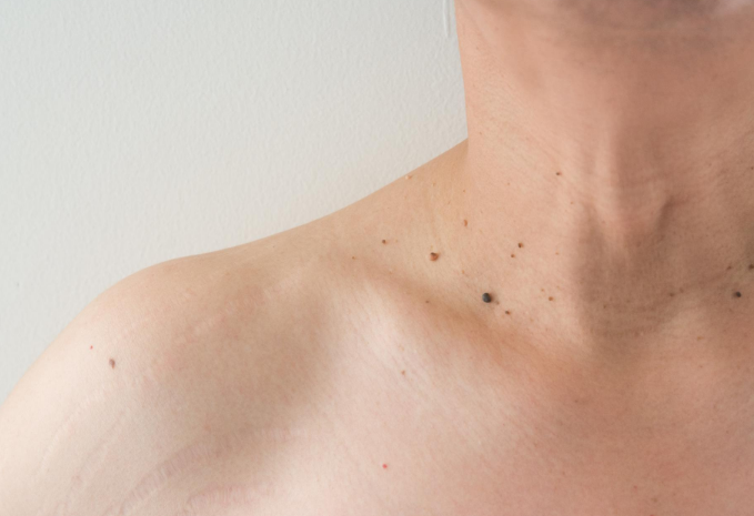 Wart vs. Skin Tag: What's The Difference & How To Treat Them